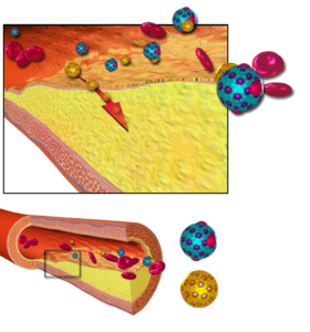 سخت‌رگی، تصلب شرایین، اتساع شرایین، گرفتگی رگ‌ها، آتروماتوزیس، Atheromatosis