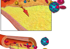 سخت‌رگی، تصلب شرایین، اتساع شرایین، گرفتگی رگ‌ها، آتروماتوزیس، Atheromatosis