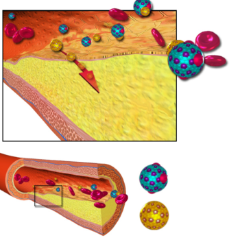 سخت‌رگی، تصلب شرایین، اتساع شرایین، گرفتگی رگ‌ها، آتروماتوزیس، Atheromatosis